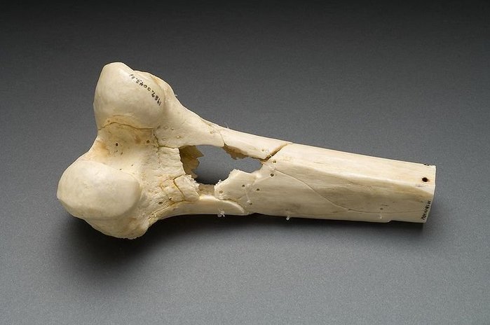 관통된 전사자의 뼈. 남북전쟁 당시의 부검 유물 중 하나. <출처: Public Domain>
